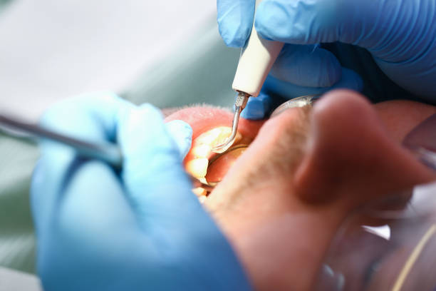 Best Chipped Tooth Repair Near Me  in Attica, MI